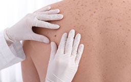 melanoma surgery