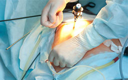 bowel cancer surgery