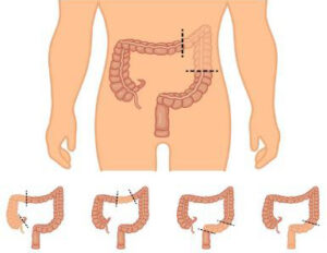 Laparoscopic Colectomy Surgery Johannesburg