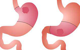 Gastrectomy