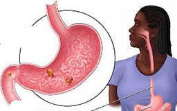 Gastrointestinal Stromal Tumour (GIST) Surgery