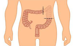 Laparoscopic Colectomy