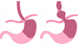 Laparoscopic Hiatal Hernia Repair