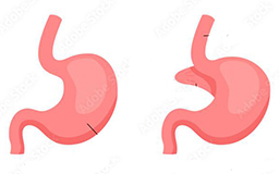 Laparoscopic Nissen Funduplication