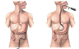 Upper and Lower Endoscopy